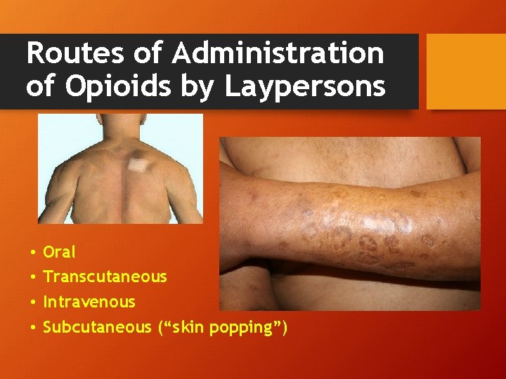 Routes of Administration of Opioids by Laypersons • • Oral Transcutaneous Intravenous Subcutaneous (“skin