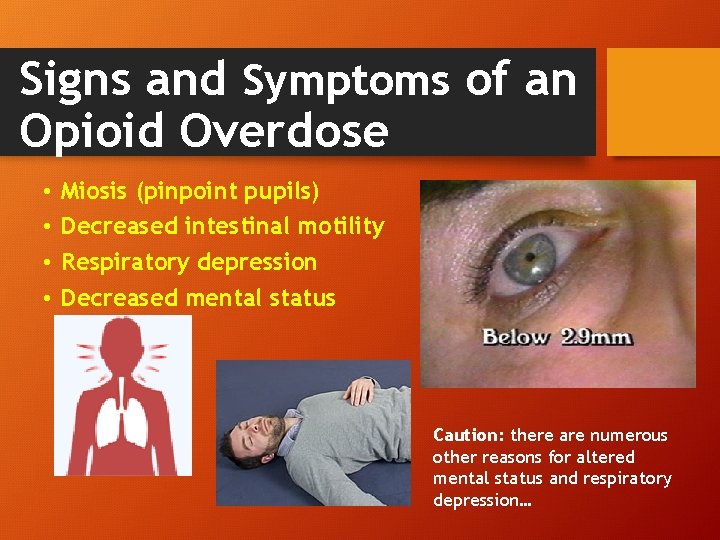 Signs and Symptoms of an Opioid Overdose • • Miosis (pinpoint pupils) Decreased intestinal