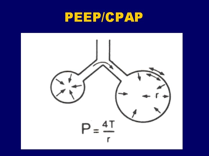 PEEP/CPAP 