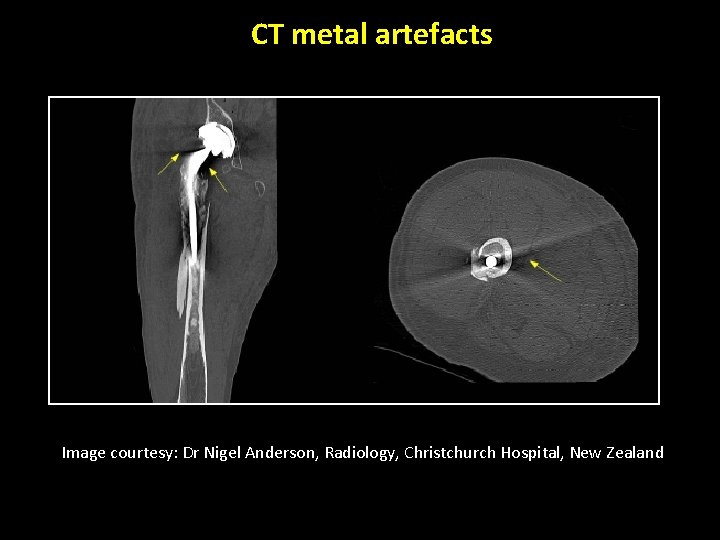 CT metal artefacts Image courtesy: Dr Nigel Anderson, Radiology, Christchurch Hospital, New Zealand 24