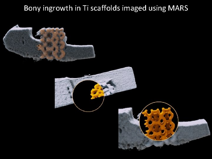 Bony ingrowth in Ti scaffolds imaged using MARS 