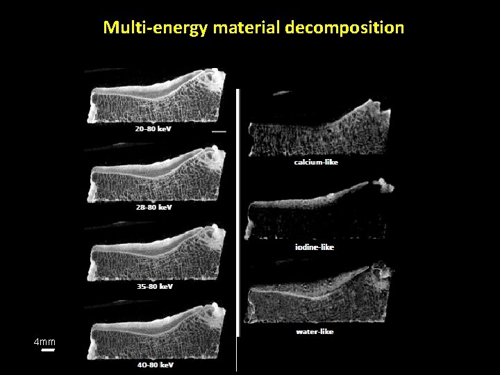 Multi-energy material decomposition 4 mm 