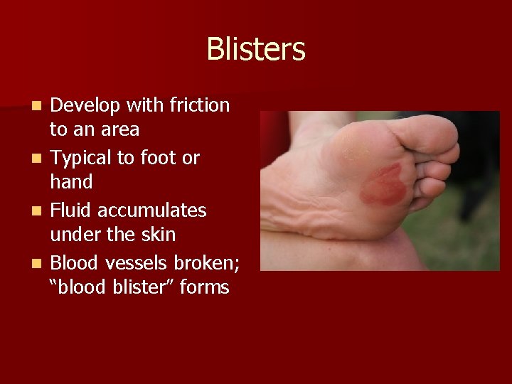 Blisters n n Develop with friction to an area Typical to foot or hand