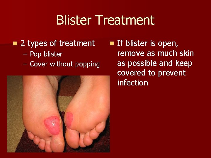 Blister Treatment n 2 types of treatment – Pop blister – Cover without popping