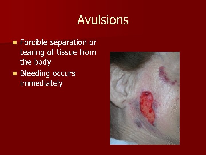 Avulsions Forcible separation or tearing of tissue from the body n Bleeding occurs immediately
