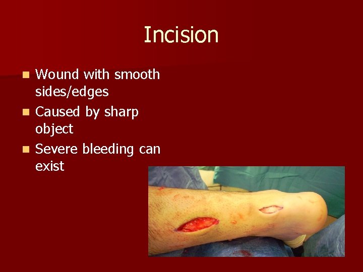Incision Wound with smooth sides/edges n Caused by sharp object n Severe bleeding can
