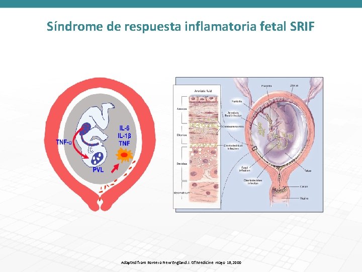 Síndrome de respuesta inflamatoria fetal SRIF Adapted from Romero New England J. Of Medicine