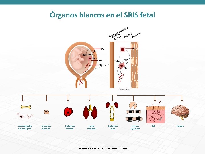 Órganos blancos en el SRIS fetal Anormalidades Hematológicas Activación Endocrina Disfunción Cardiaca Injuria Pulmonar