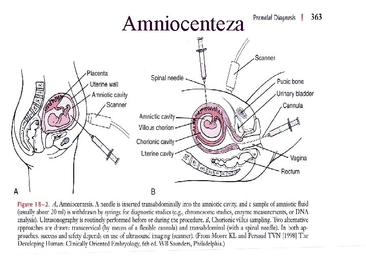 Amniocenteza 