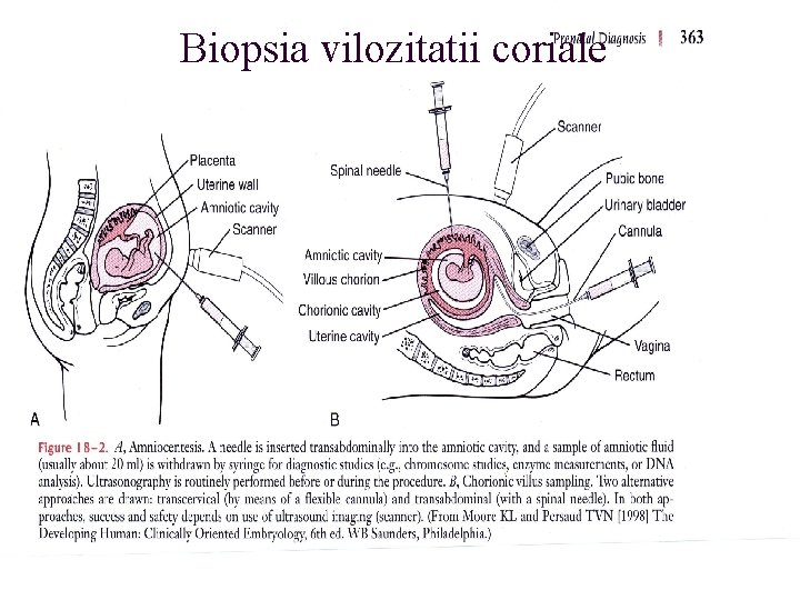 Biopsia vilozitatii coriale 