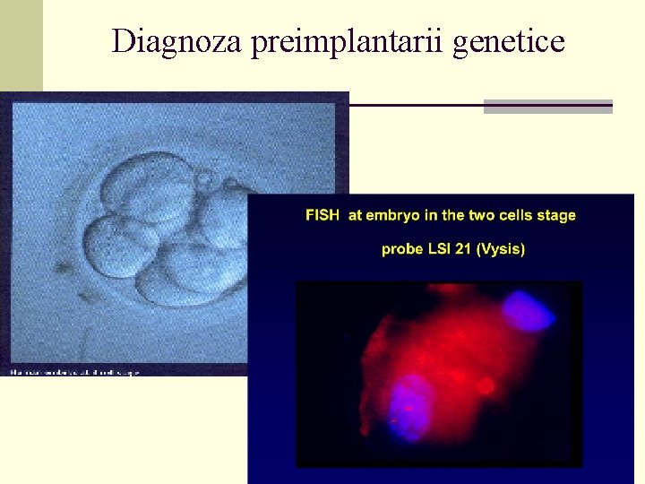 Diagnoza preimplantarii genetice 