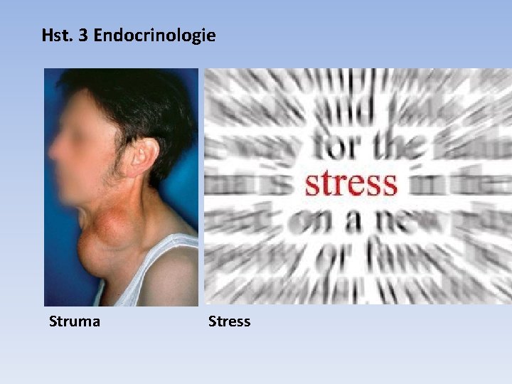 Hst. 3 Endocrinologie Struma Stress 