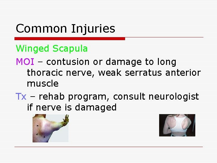 Common Injuries Winged Scapula MOI – contusion or damage to long thoracic nerve, weak