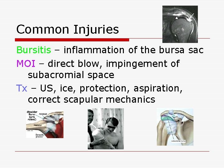 Common Injuries Bursitis – inflammation of the bursa sac MOI – direct blow, impingement