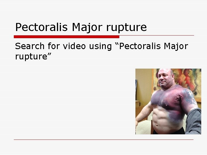 Pectoralis Major rupture Search for video using “Pectoralis Major rupture” 