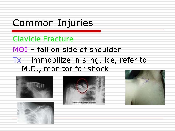 Common Injuries Clavicle Fracture MOI – fall on side of shoulder Tx – immobilize