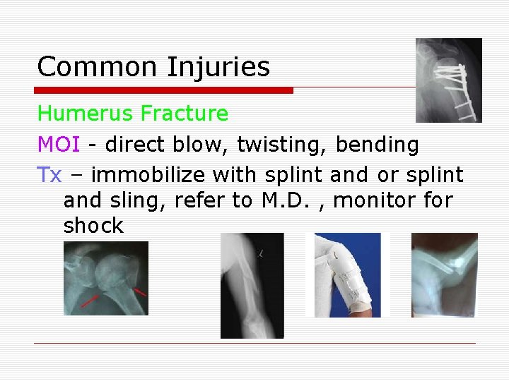 Common Injuries Humerus Fracture MOI - direct blow, twisting, bending Tx – immobilize with