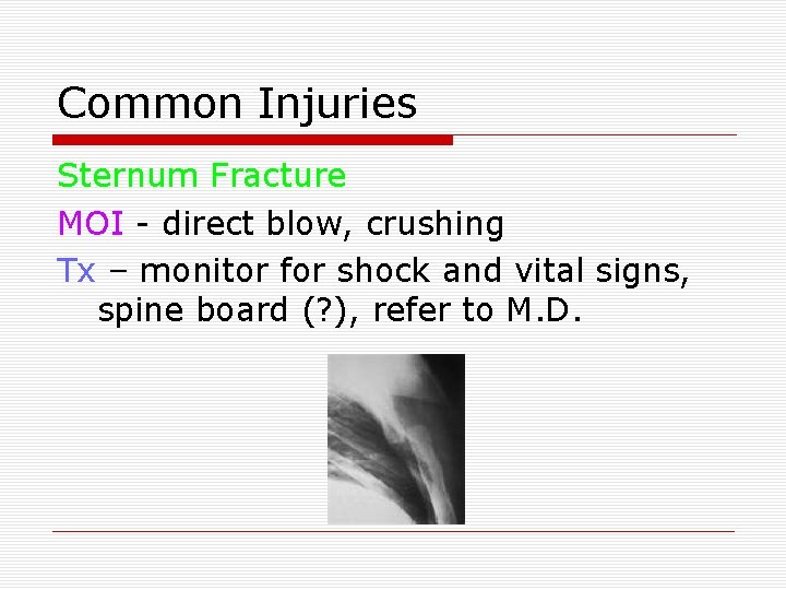 Common Injuries Sternum Fracture MOI - direct blow, crushing Tx – monitor for shock