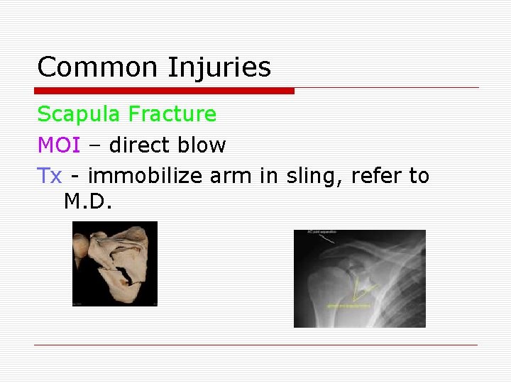 Common Injuries Scapula Fracture MOI – direct blow Tx - immobilize arm in sling,