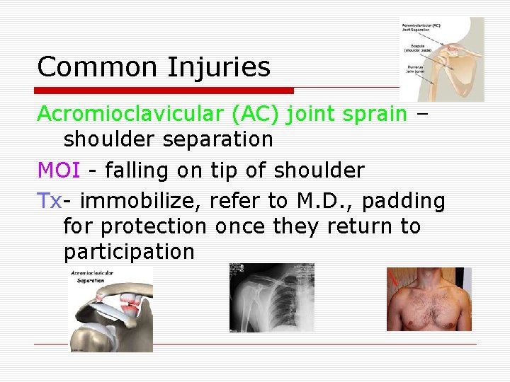 Common Injuries Acromioclavicular (AC) joint sprain – shoulder separation MOI - falling on tip