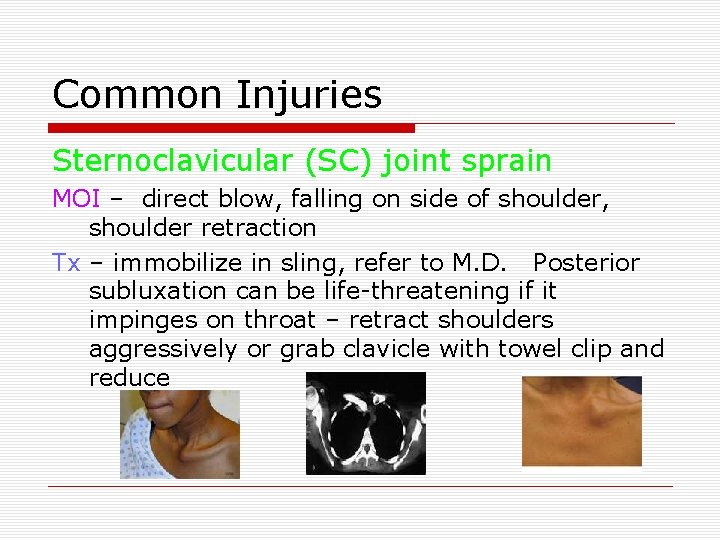 Common Injuries Sternoclavicular (SC) joint sprain MOI – direct blow, falling on side of