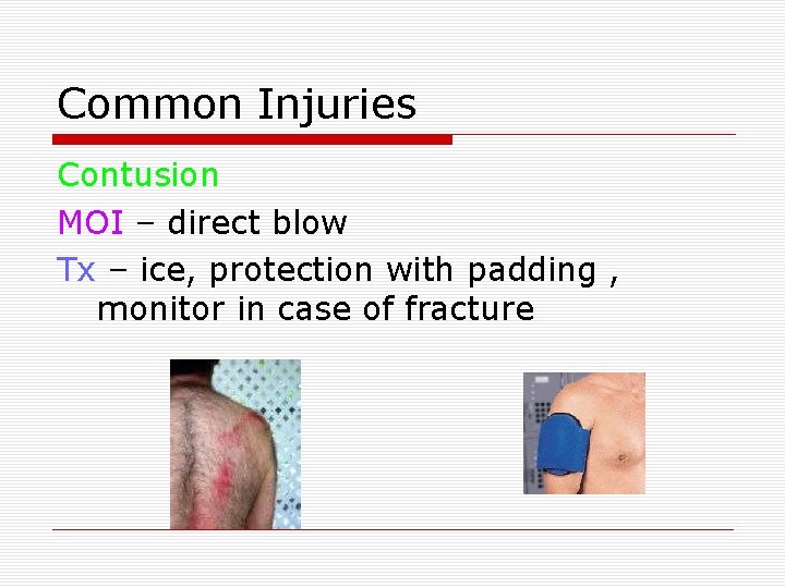 Common Injuries Contusion MOI – direct blow Tx – ice, protection with padding ,