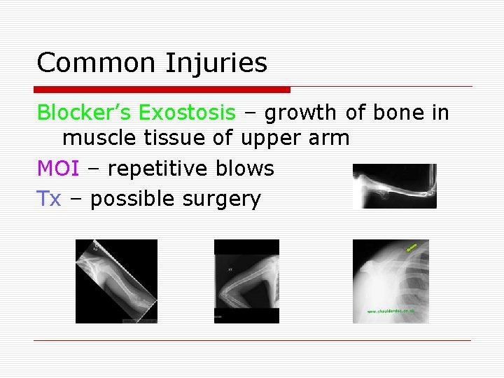 Common Injuries Blocker’s Exostosis – growth of bone in muscle tissue of upper arm