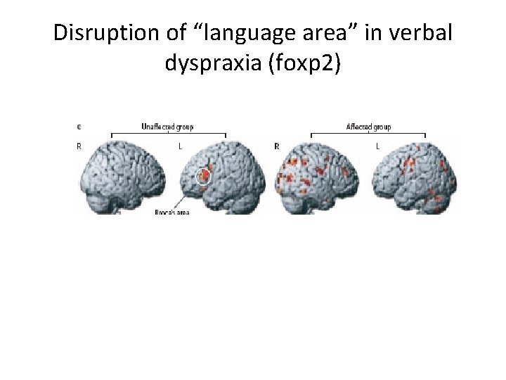 Disruption of “language area” in verbal dyspraxia (foxp 2) 
