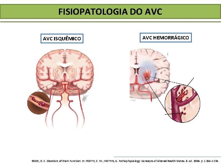 FISIOPATOLOGIA DO AVC ISQUÊMICO AVC HEMORRÁGICO BOOK, D. S. Disorders of Brain Function. In: