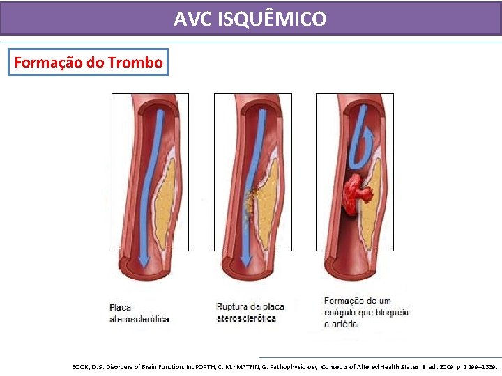 AVC ISQUÊMICO Formação do Trombo BOOK, D. S. Disorders of Brain Function. In: PORTH,