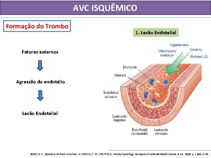 AVC ISQUÊMICO Formação do Trombo 1. Lesão Endotelial Fatores externos Agressão do endotélio Lesão