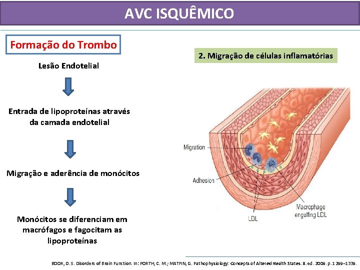 AVC ISQUÊMICO Formação do Trombo Lesão Endotelial 2. Migração de células inflamatórias Entrada de