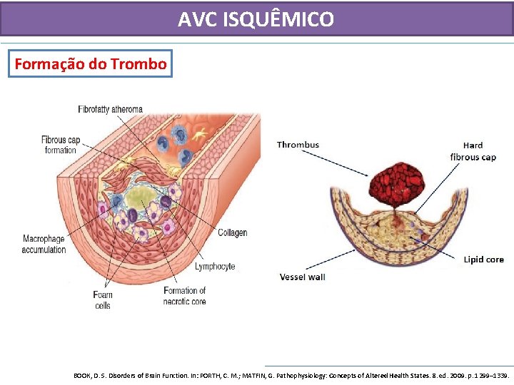 AVC ISQUÊMICO Formação do Trombo BOOK, D. S. Disorders of Brain Function. In: PORTH,