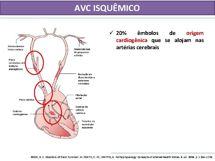 AVC ISQUÊMICO ü 20% êmbolos de origem cardiogênica que se alojam nas artérias cerebrais