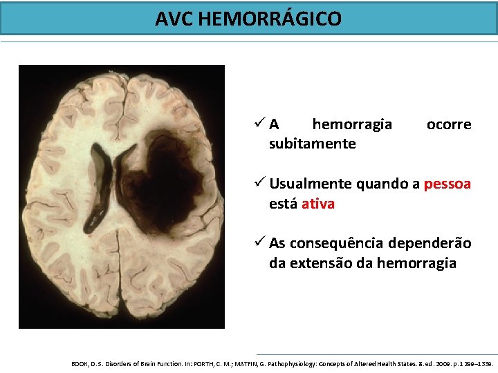 AVC HEMORRÁGICO üA hemorragia subitamente ocorre ü Usualmente quando a pessoa está ativa ü