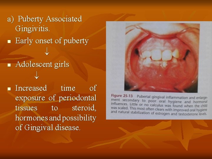a) Puberty Associated Gingivitis. n Early onset of puberty n Adolescent girls n Increased