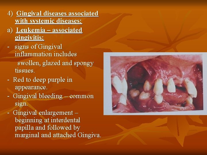 4) Gingival diseases associated with systemic diseases: a) Leukemia – associated gingivitis: - signs