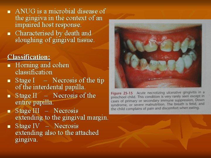 n n ANUG is a microbial disease of the gingiva in the context of