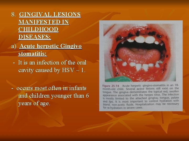 8. GINGIVAL LESIONS MANIFESTED IN CHILDHOOD DISEASES: a) Acute herpetic Gingivo stomatitis: - It