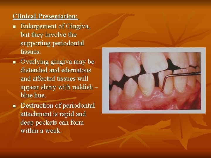Clinical Presentation: n Enlargement of Gingiva, but they involve the supporting periodontal tissues. n
