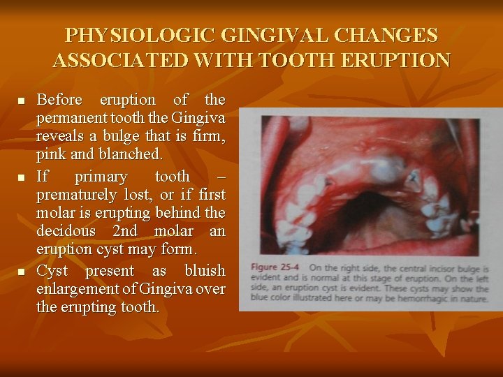 PHYSIOLOGIC GINGIVAL CHANGES ASSOCIATED WITH TOOTH ERUPTION n n n Before eruption of the