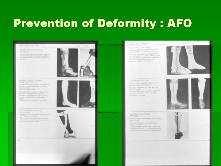 Prevention of Deformity : AFO 