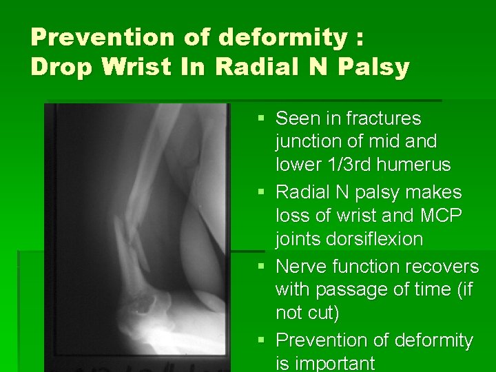 Prevention of deformity : Drop Wrist In Radial N Palsy § Seen in fractures
