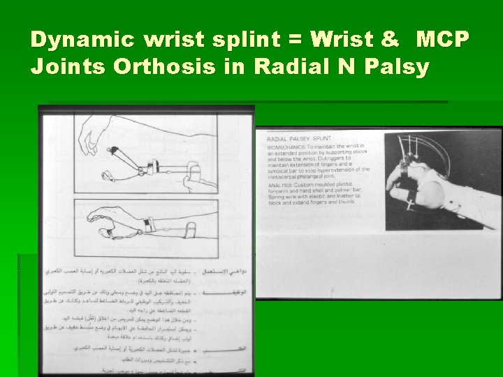 Dynamic wrist splint = Wrist & MCP Joints Orthosis in Radial N Palsy 