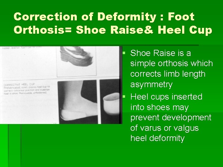 Correction of Deformity : Foot Orthosis= Shoe Raise& Heel Cup § Shoe Raise is