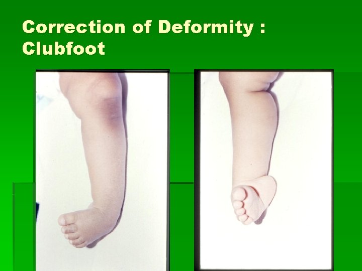Correction of Deformity : Clubfoot 