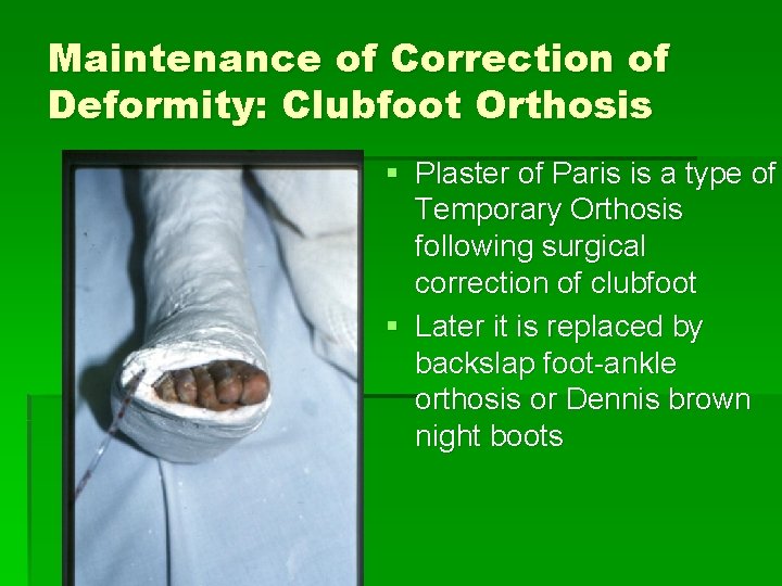 Maintenance of Correction of Deformity: Clubfoot Orthosis § Plaster of Paris is a type