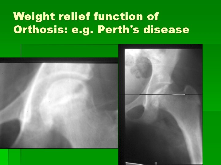 Weight relief function of Orthosis: e. g. Perth's disease 