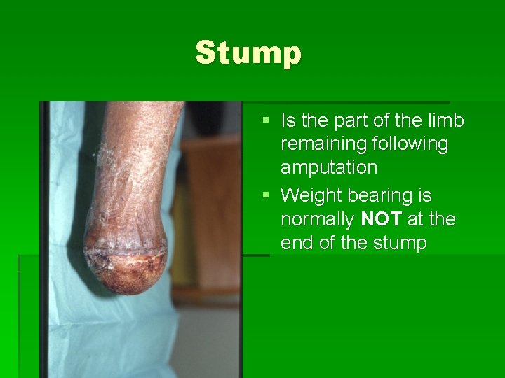 Stump § Is the part of the limb remaining following amputation § Weight bearing