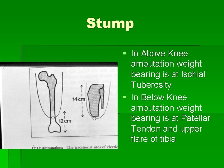 Stump § In Above Knee amputation weight bearing is at Ischial Tuberosity § In
